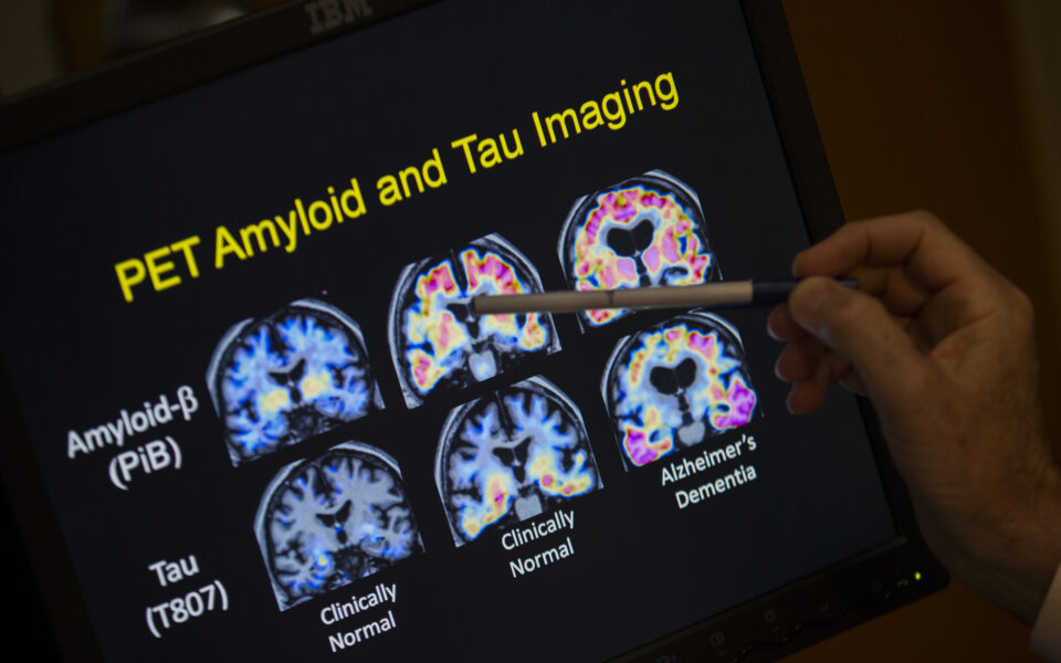 Progress against Alzheimer’s